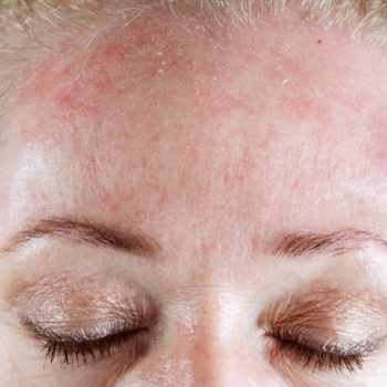 Menopauze en huidproblemen Menopauze en huidproblemen