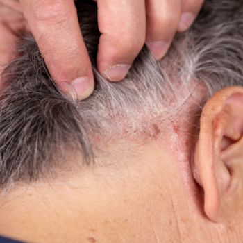 Testosteron en huidproblemen